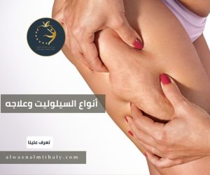 أنواع السيلوليت وعلاجه أنواع السيلوليت وعلاجه