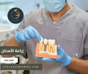 زراعة الأسنان زراعة الأسنان